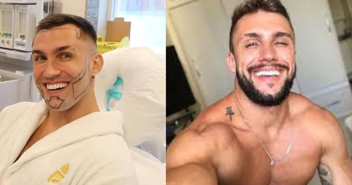 Ex-bbb Arthur Picoli surpreende ao aparecer após transplante capilar e de barba