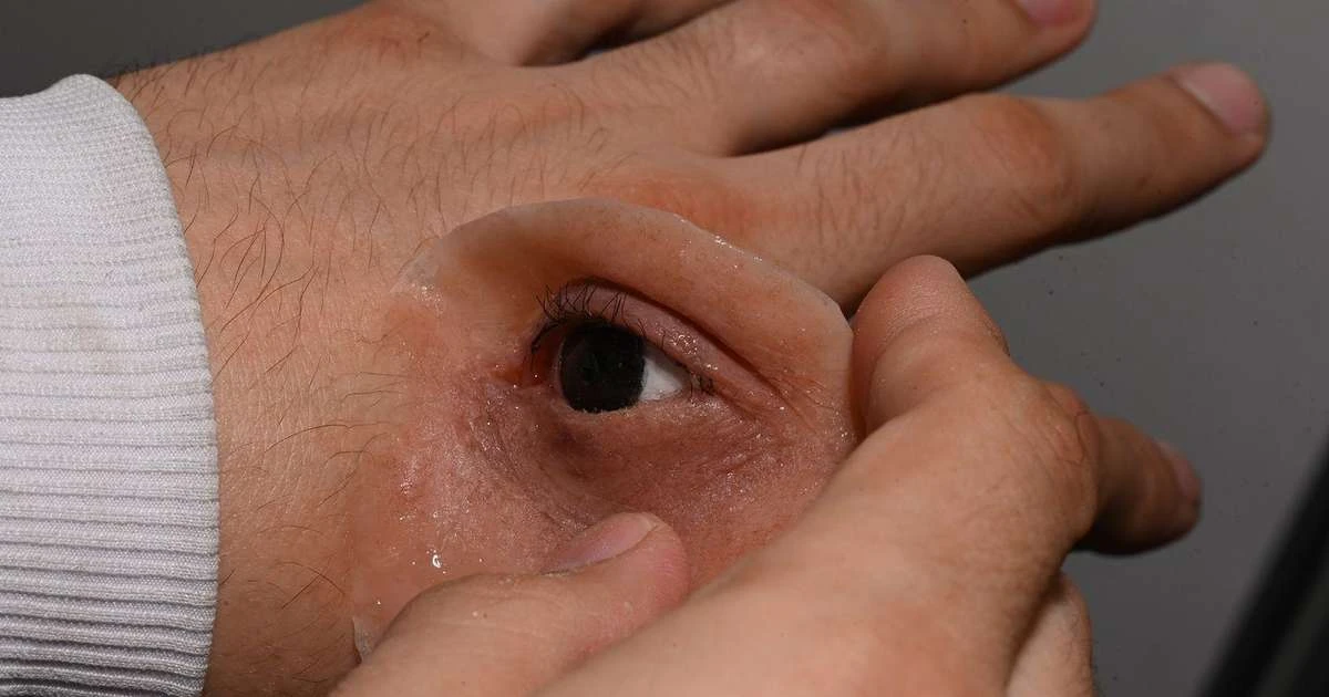 Como próteses gratuitas estão mudando a vida de pessoas após tratamento contra câncer