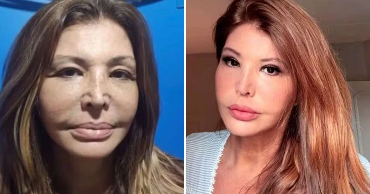 Roberta Close faz cirurgia plástica aos 60 anos e médica alerta: 'Harmonização não apaga o tempo'