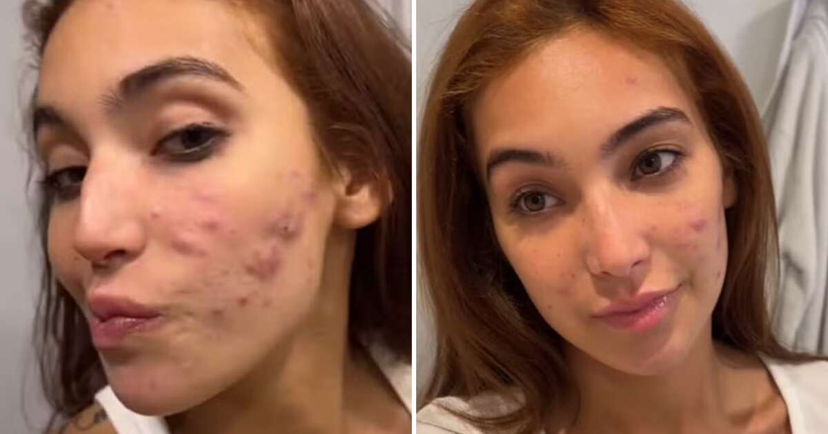 Vanessa Lopes mostra evolução em tratamento da acne: 'Doendo bem menos'