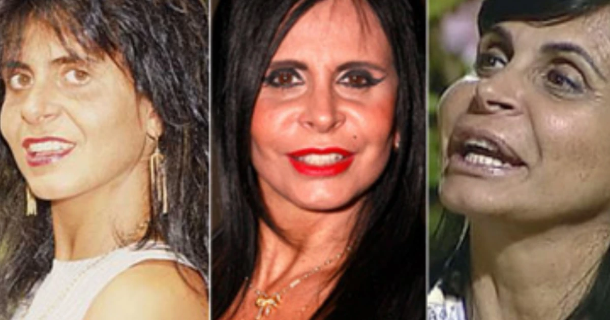 Antes e depois: 5 famosos que fizeram cirurgia plástica e mudaram drasticamente