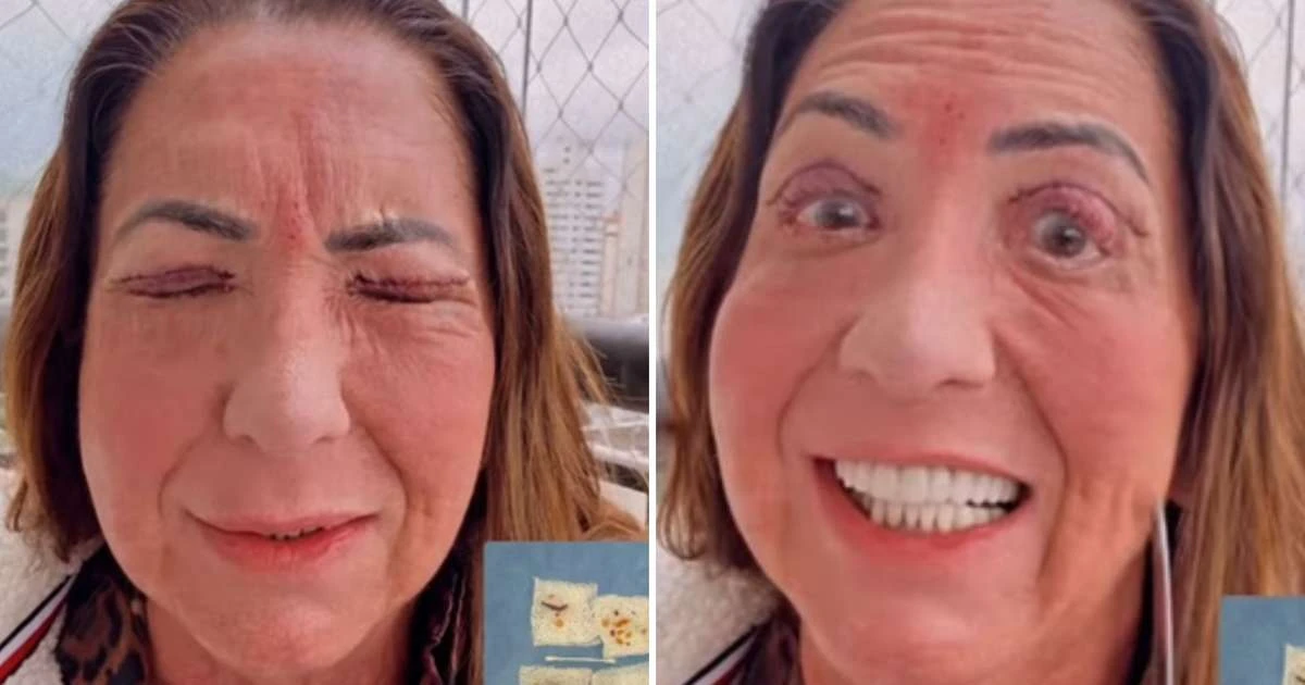 Mãe de Virginia surge irreconhecível após cirurgia nos olhos: 'Não está bonito'