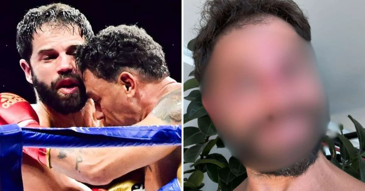 Duda Nagle surge com o rosto 'desconfigurado' após luta com Popó: 'Mão de pedra'