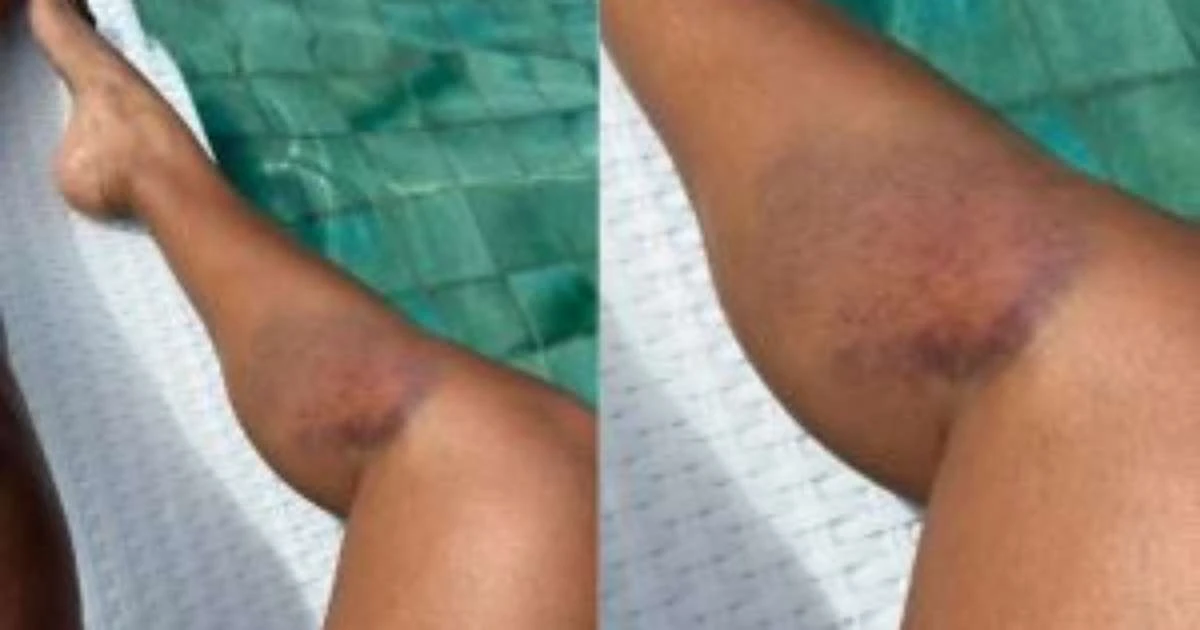 Sheron Menezzes sofre acidente e exibe hematomas após susto: 'Toda roxa'