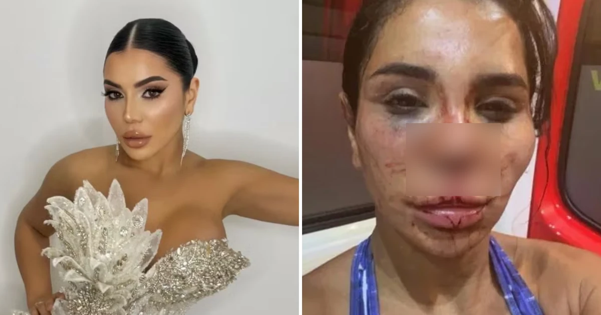 Influenciadora francesa fica desconfigurada após sofrer ataque brutal por homens armados