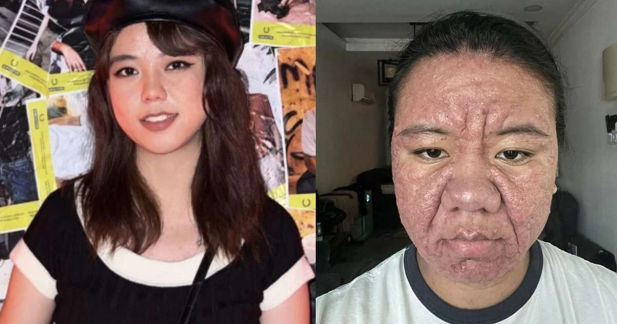 Mulher malaia choca ao exibir mudança extrema na pele durante a gravidez, vídeo viraliza e rebate críticas à sua aparência: 'Afeta minha saúde mental'