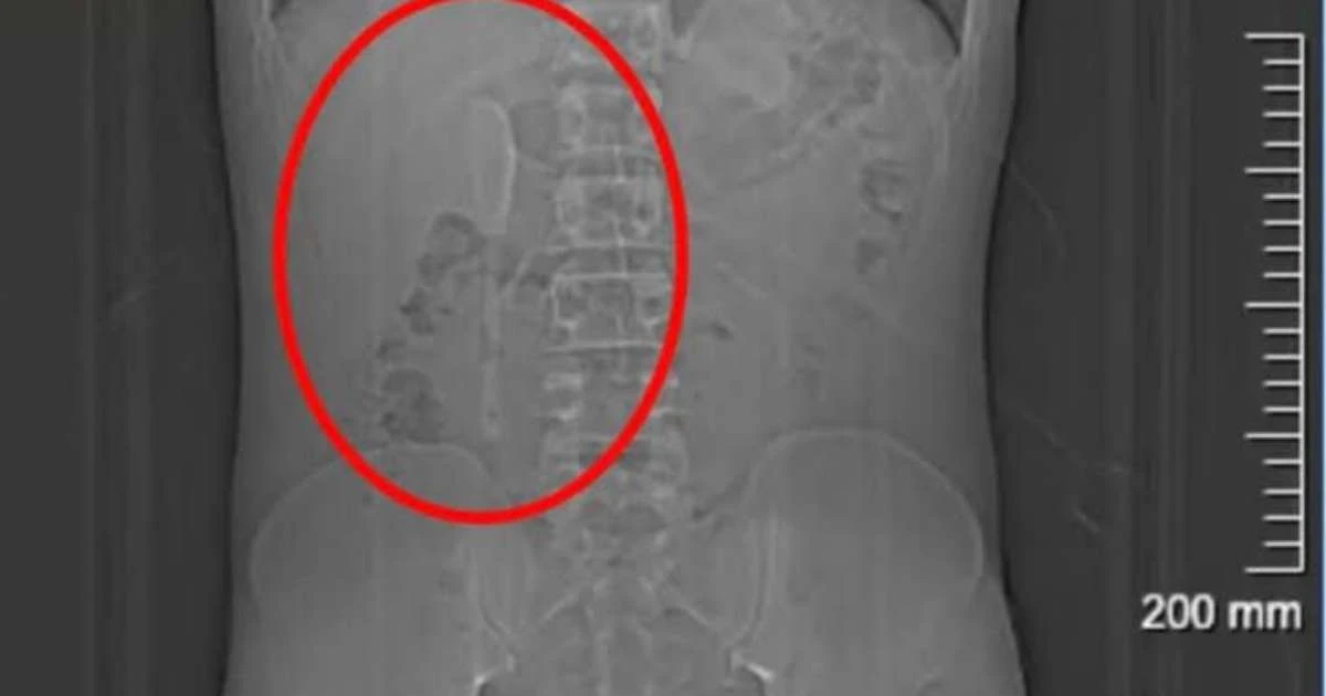 Homem bêbado engole colher de 15 centímetros e precisa passar por cirurgia no intestino
