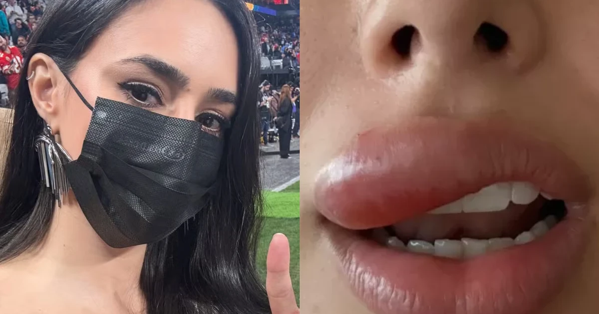 Médicas explicam problema de saúde que inchou a boca de Bruna Biancardi: 'Pode evoluir para uma meningite ou outra complicação maior'