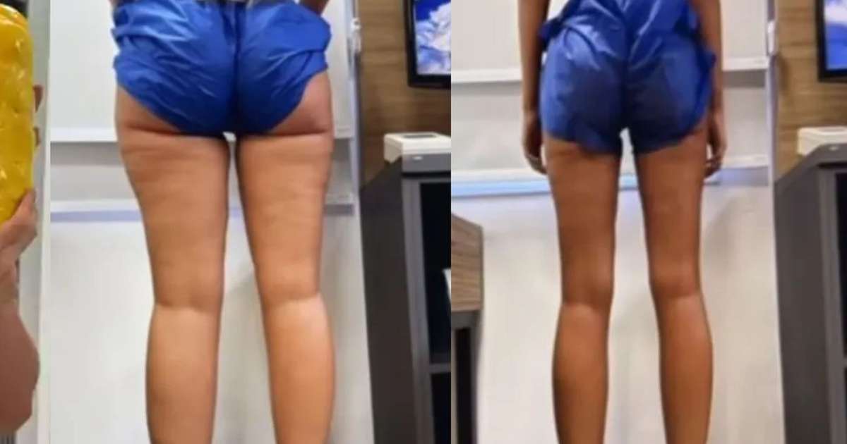 Yasmin Brunet perde 14 kg de gordura após tratamento para lipedema e foto do antes e depois impressiona: 'Muito chocada'