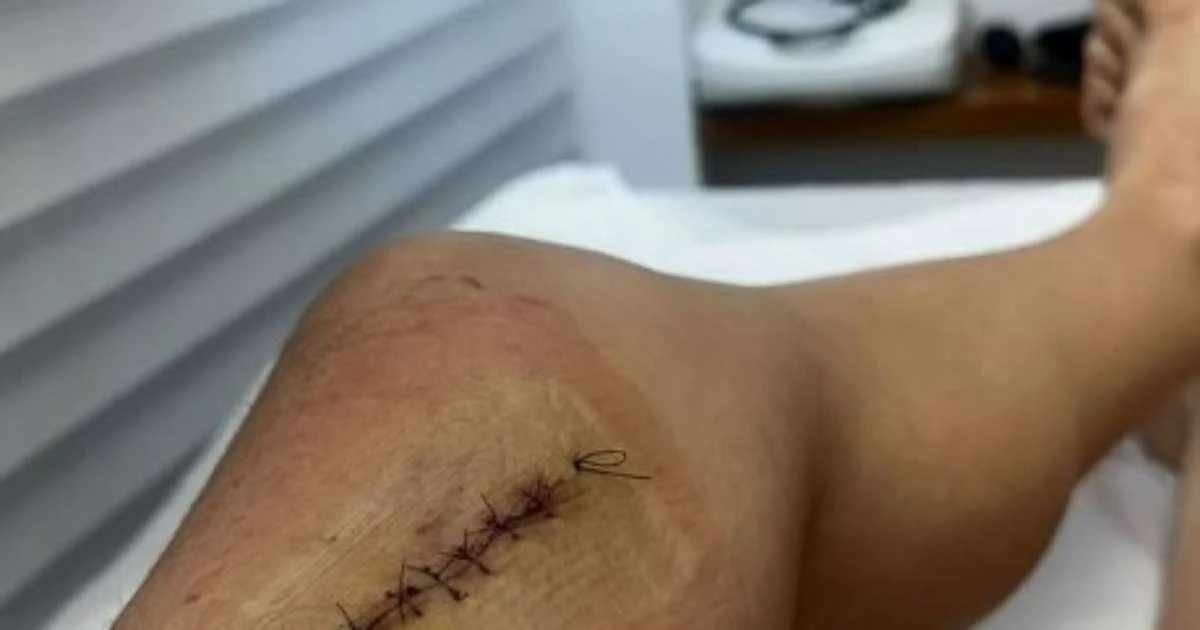 Flávia Monteiro mostra cicatriz após retirada de tumor: 'Era um câncer'