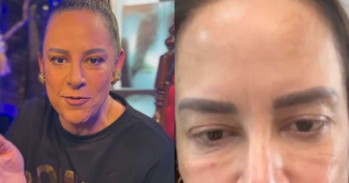 De cara lavada, Silvia Abravanel surge com o rosto inchado: 'Fiz um procedimento'