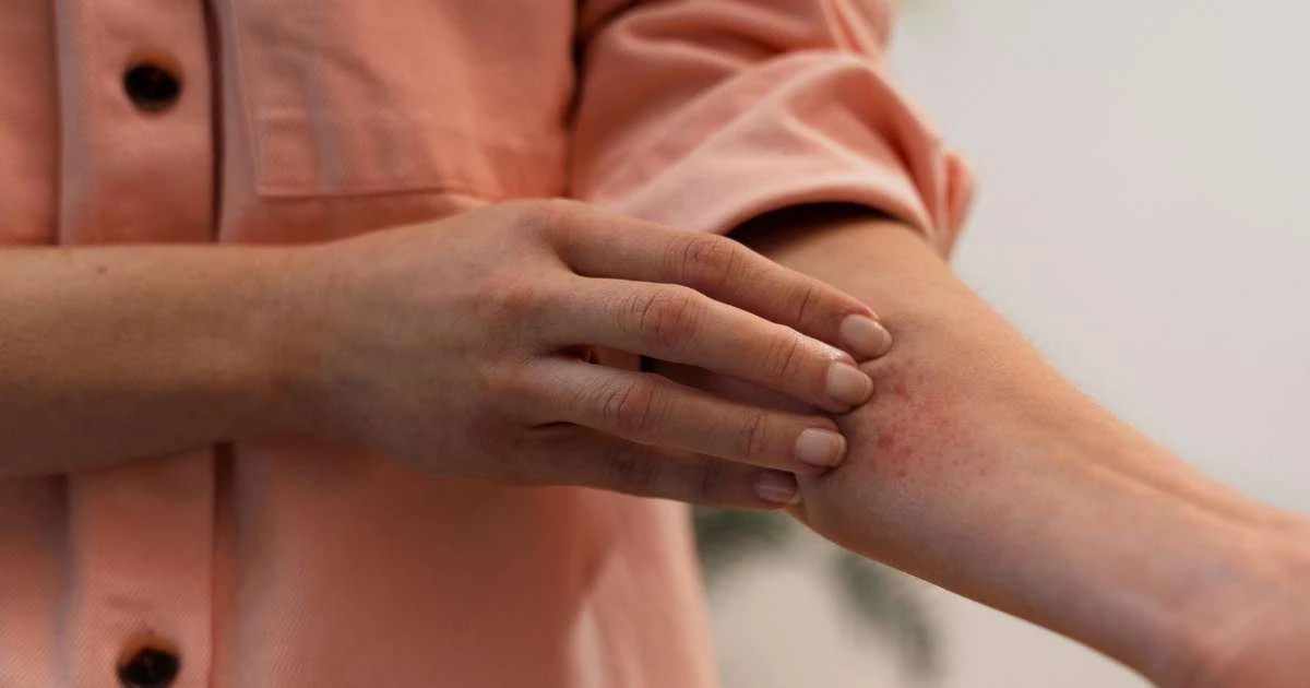 Diagnóstico tardio agrava casos de hidradenite no país