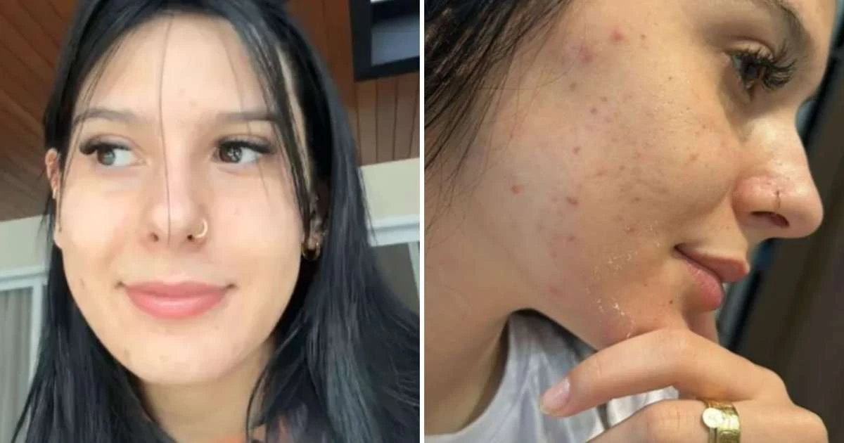 Ana Castela revela uso de medicamento severo para acne e médica alerta: 'Não é qualquer caso'