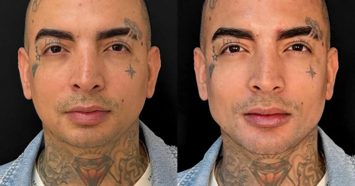 MC Guimê mostra antes e depois de harmonização facial: 'Ficou bem natural'