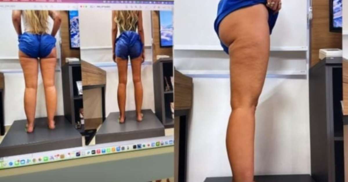 Yasmin Brunet mostra o resultado do tratamento para lipedema; veja antes e depois