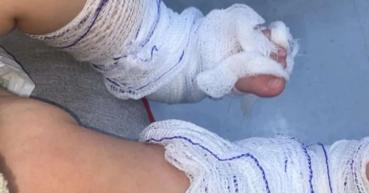 Bebê sofre queimaduras graves após banho em creche