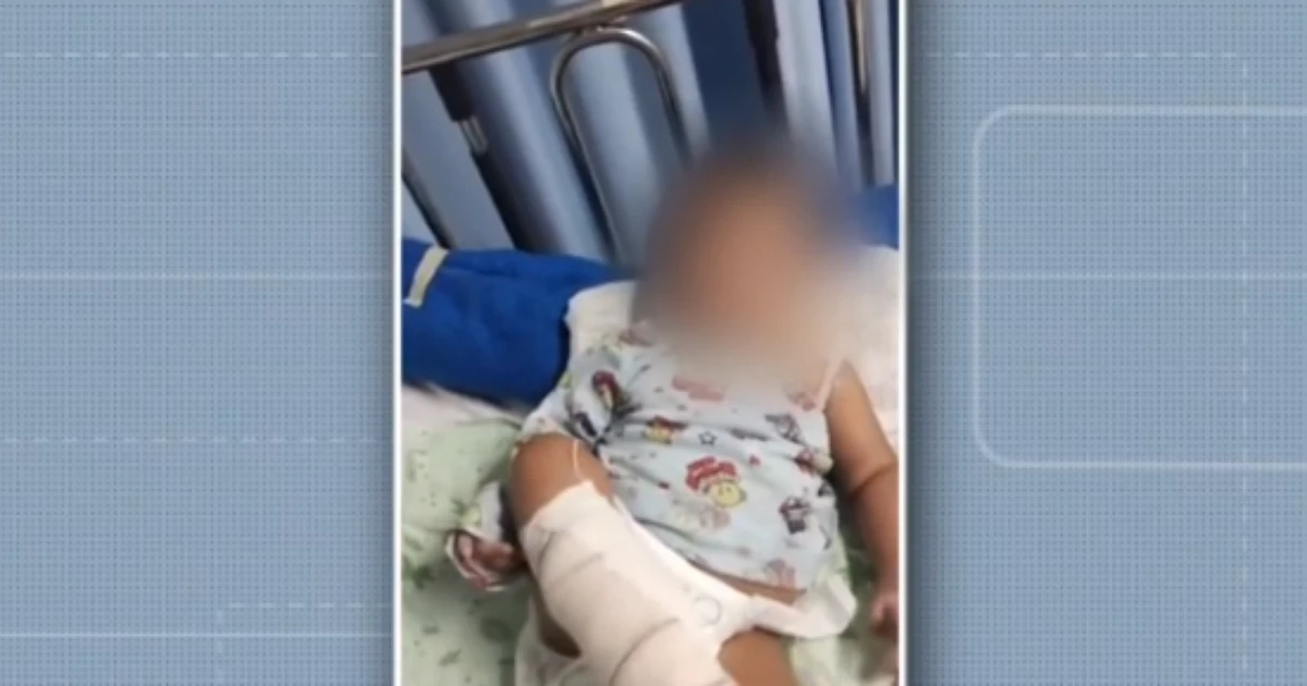Bebê é internado com bronquiolite e precisa amputar o pé; família acusa hospital de negligência