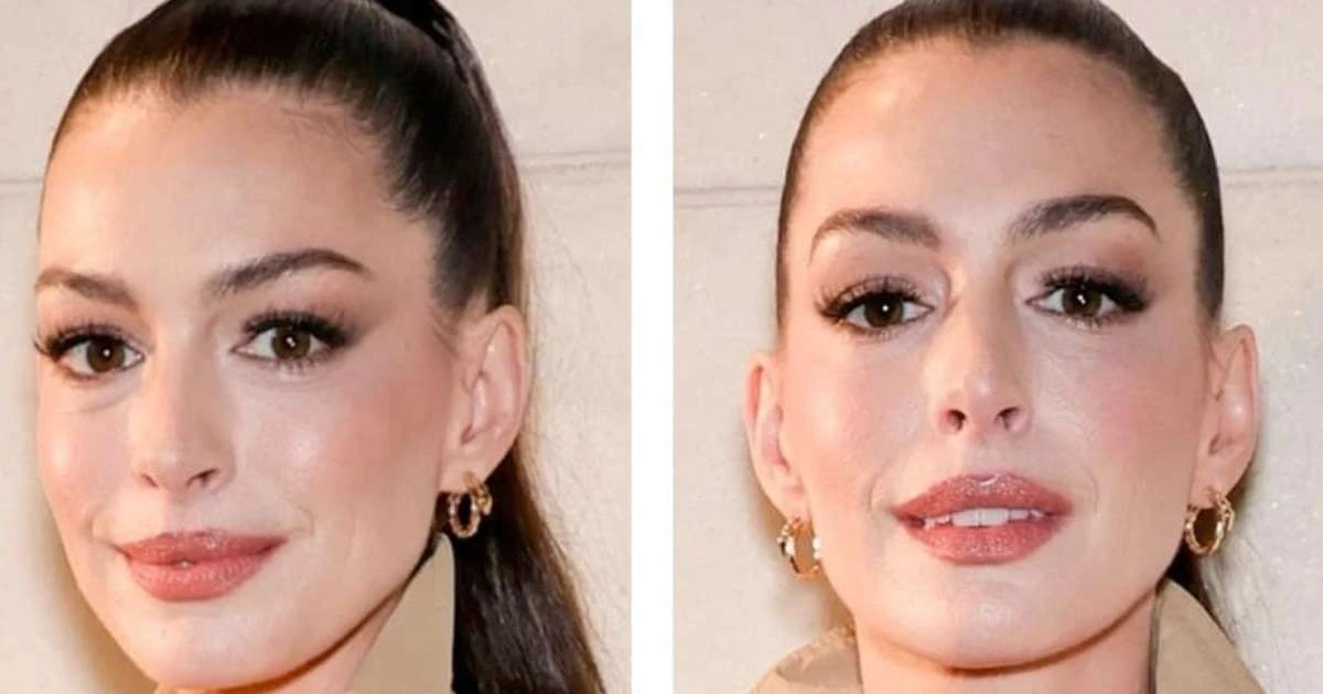 Caso Anne Hathaway: é possível fazer cirurgia plástica sem que ninguém perceba?