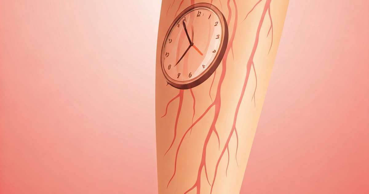 Diagnóstico precoce melhora tratamentos para varizes