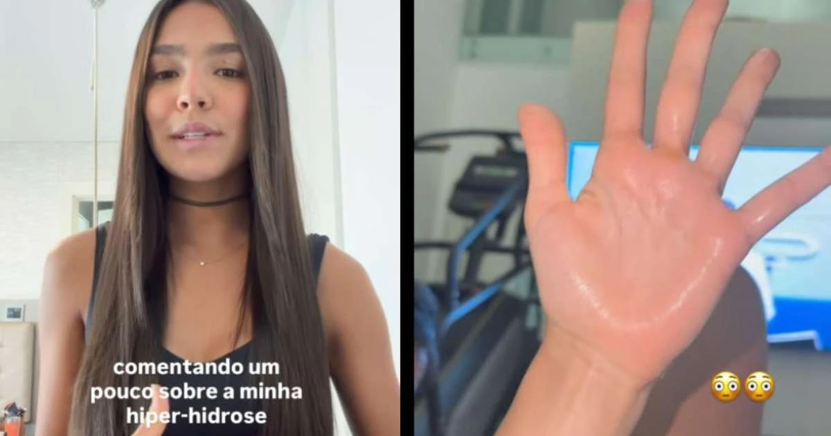 O que é hiperidrose, condição que afeta Duda Guerra nas mãos e pés?