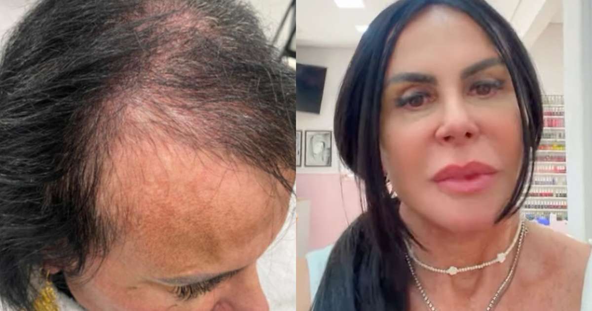 Gretchen exibe fios mais fortes após tratamento de alopecia; veja o antes e depois!