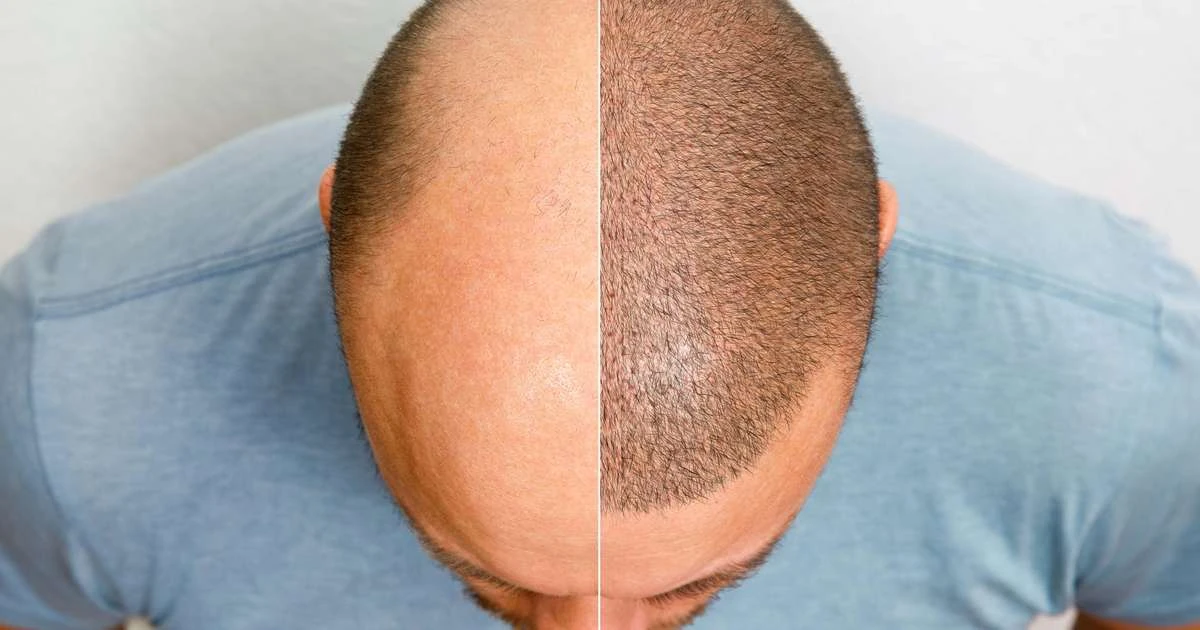 Personalização maximiza efeitos do transplante capilar