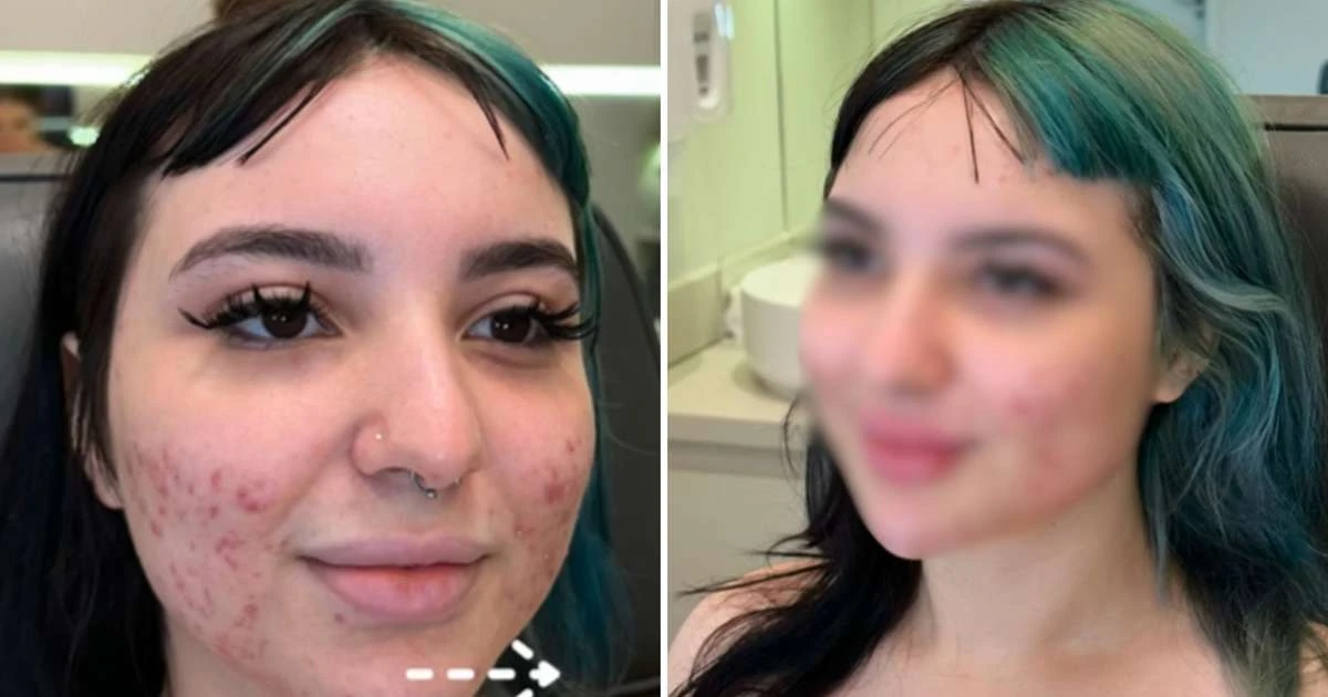 Aos 19 anos, influencer gasta R$ 100 mil para harmonizar o rosto: 'Mudou nada'